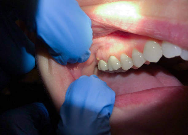 Best Cracked Tooth Emergency Dentist  in Crow Agency, MT